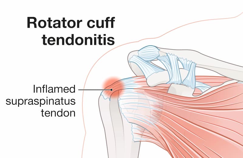 ból barku po treningu, trening medyczny wrocław